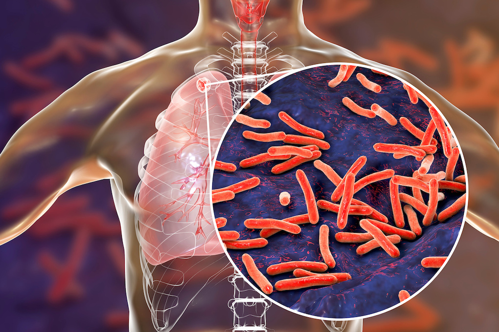 tuberculosis in lungs 3D illustration jpeg